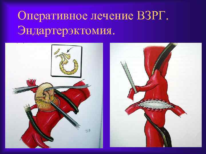 Оперативное лечение ВЗРГ. Эндартерэктомия. 