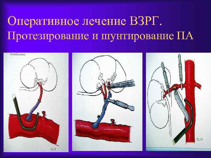 Оперативное лечение ВЗРГ. Протезирование и шунтирование ПА 