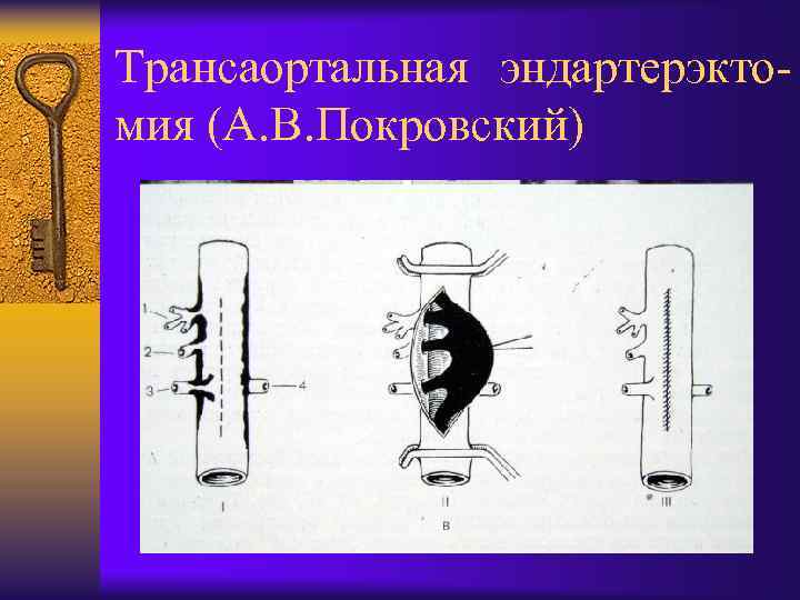 Трансаортальная эндартерэктомия (А. В. Покровский) 