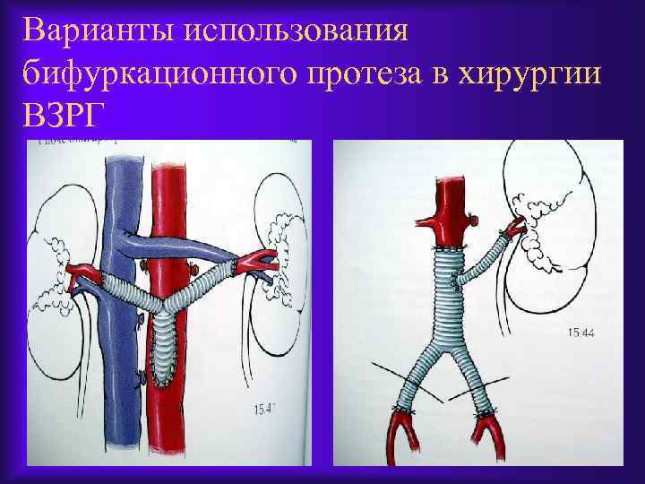 Варианты использования бифуркационного протеза в хирургии ВЗРГ 