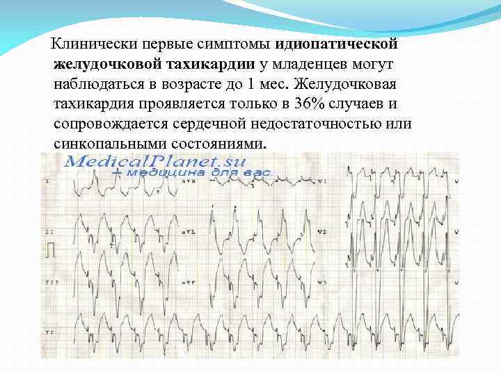 Клинически первые симптомы идиопатической желудочковой тахикардии у младенцев могут наблюдаться в возрасте до 1