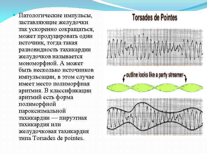  Патологические импульсы, заставляющие желудочки так ускоренно сокращаться, может продуцировать один источник, тогда такая