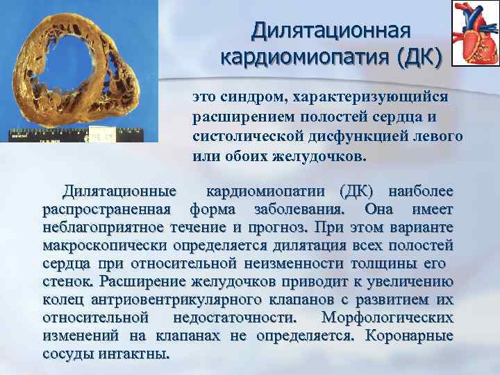 Дилятационная кардиомиопатия (ДК) это синдром, характеризующийся расширением полостей сердца и систолической дисфункцией левого или