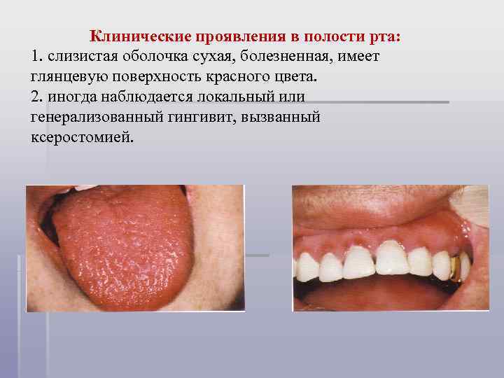Клинические проявления в полости рта: 1. слизистая оболочка сухая, болезненная, имеет глянцевую поверхность красного