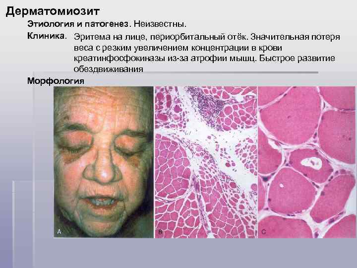 Дерматомиозит Этиология и патогенез. Неизвестны. Клиника. Эритема на лице, периорбитальный отёк. Значительная потеря веса