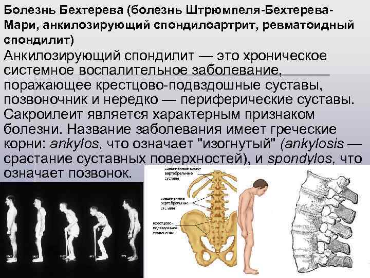 Болезнь Бехтерева (болезнь Штрюмпеля-Бехтерева. Мари, анкилозирующий спондилоартрит, ревматоидный спондилит) Анкилозирующий спондилит — это хроническое