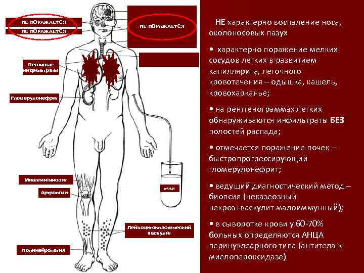 НЕ ПОРАЖАЕТСЯ Поднадгортанниковый стеноз Легочные инфильтраты Гломерулонефрит • НЕ характерно воспаление носа, околоносовых пазух