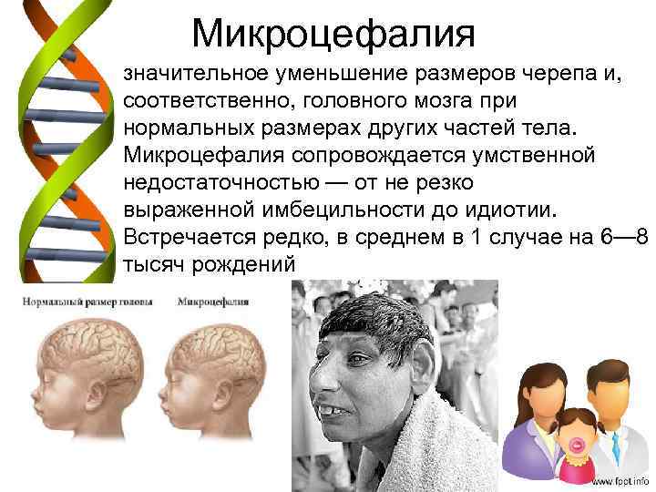 Микроцефалия значительное уменьшение размеров черепа и, соответственно, головного мозга при нормальных размерах других частей