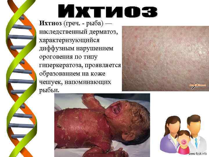 Ихтиоз (греч. - рыба) — наследственный дерматоз, характеризующийся диффузным нарушением ороговения по типу гиперкератоза,