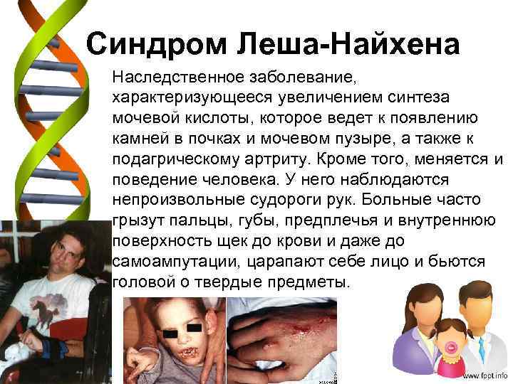 Синдром Леша-Найхена Наследственное заболевание, характеризующееся увеличением синтеза мочевой кислоты, которое ведет к появлению камней