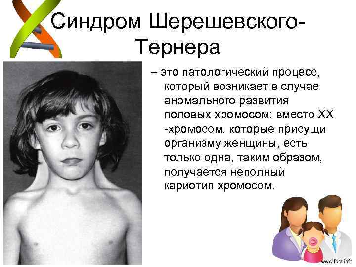 Синдром Шерешевского. Тернера – это патологический процесс, который возникает в случае аномального развития половых