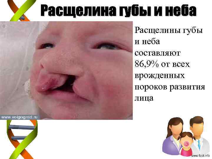  • Расщелины губы и неба составляют 86, 9% от всех врожденных пороков развития