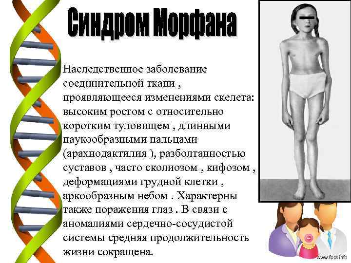 Наследственное заболевание соединительной ткани , проявляющееся изменениями скелета: высоким ростом с относительно коротким туловищем