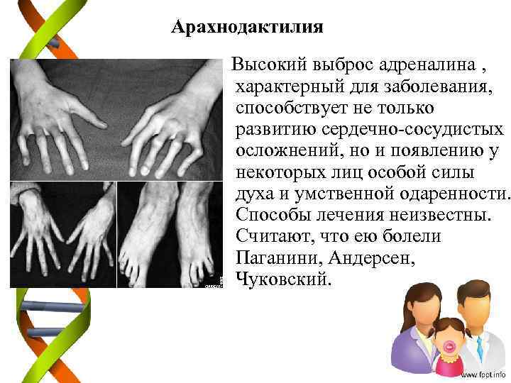 Арахнодактилия Высокий выброс адреналина , характерный для заболевания, способствует не только развитию сердечно-сосудистых осложнений,