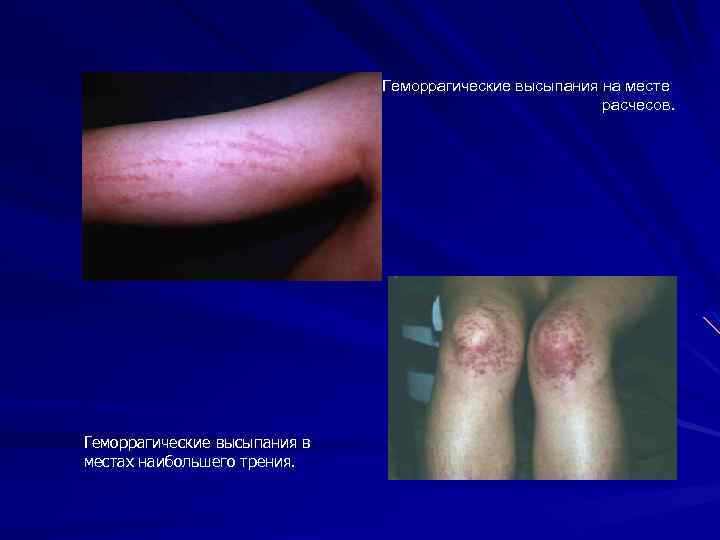 Геморрагические высыпания на месте расчесов. Геморрагические высыпания в местах наибольшего трения. 
