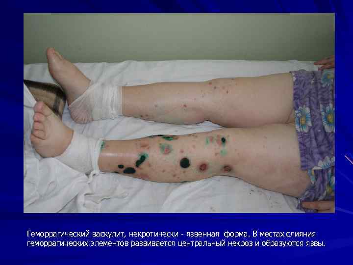 Геморрагический васкулит, некротически - язвенная форма. В местах слияния геморрагических элементов развивается центральный некроз