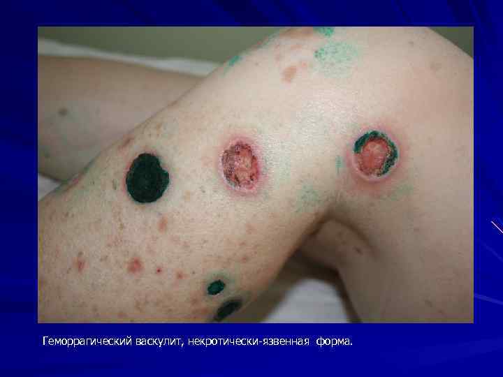 Геморрагический васкулит, некротически-язвенная форма. 