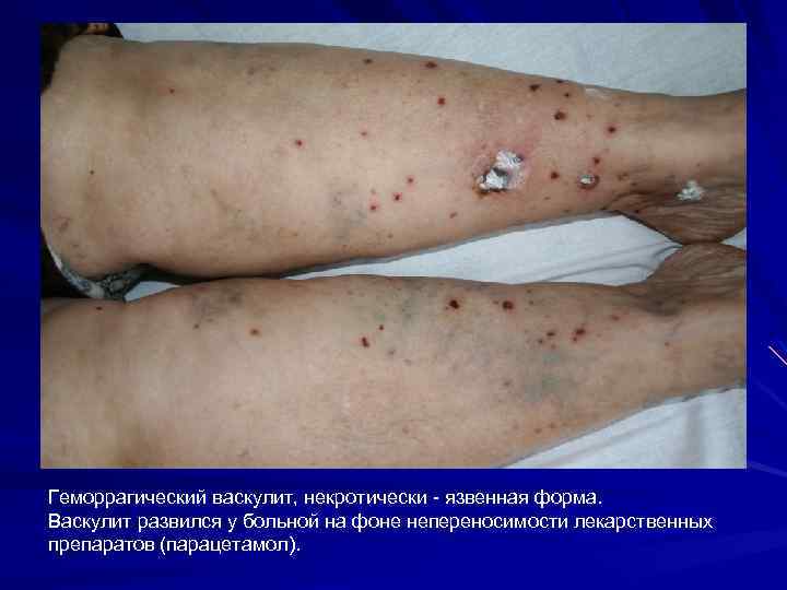 Геморрагический васкулит, некротически - язвенная форма. Васкулит развился у больной на фоне непереносимости лекарственных