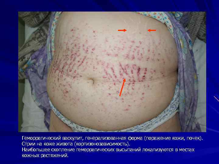 Геморрагический васкулит, генерализованная форма (поражение кожи, почек). Стрии на коже живота (кортизонозависимость). Наибольшее скопление