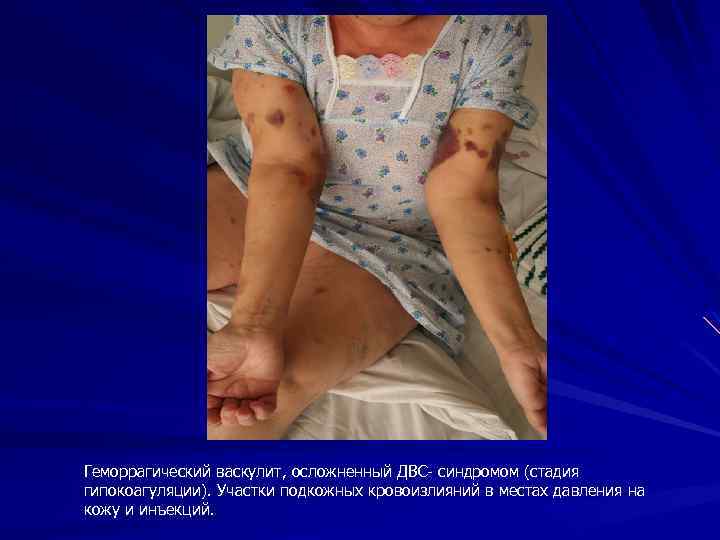 Геморрагический васкулит, осложненный ДВС- синдромом (стадия гипокоагуляции). Участки подкожных кровоизлияний в местах давления на