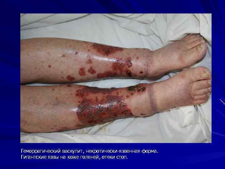Геморрагический васкулит, некротически-язвенная форма. Гигантские язвы на коже голеней, отеки стоп. 
