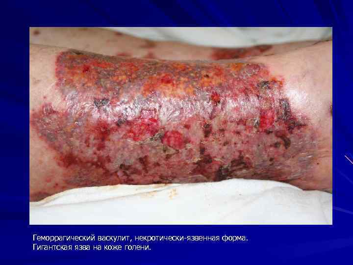 Геморрагический васкулит, некротически-язвенная форма. Гигантская язва на коже голени. 