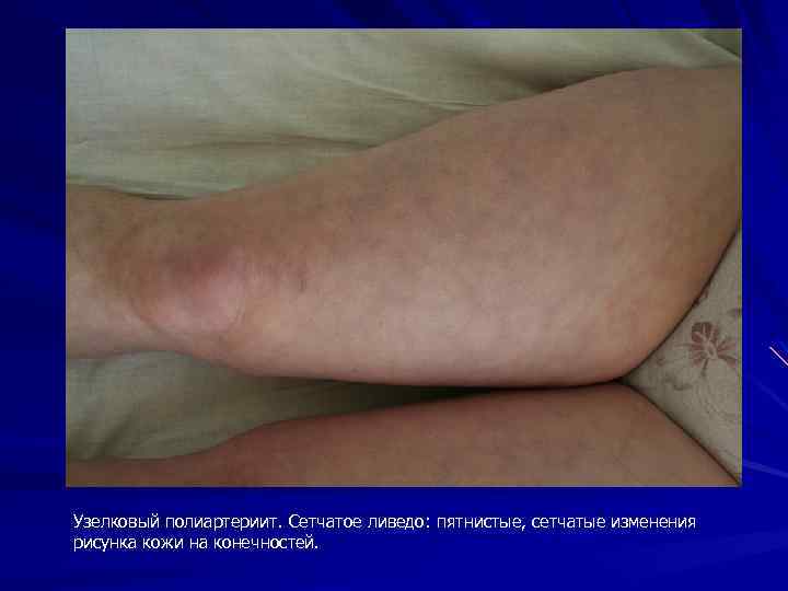 Узелковый полиартериит. Сетчатое ливедо: пятнистые, сетчатые изменения рисунка кожи на конечностей. 