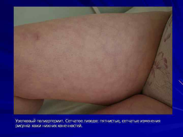 Узелковый полиартериит. Сетчатое ливедо: пятнистые, сетчатые изменения рисунка кожи нижних конечностей. 