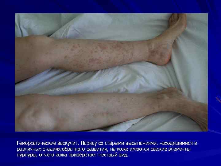 Геморрагические васкулит. Наряду со старыми высыпаниями, находящимися в различных стадиях обратного развития, на коже