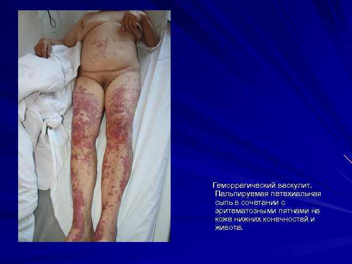 Геморрагический васкулит. Пальпируемая петехиальная сыпь в сочетании с эритематозными пятнами на коже нижних конечностей