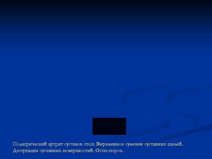 Подагрический артрит суставов стоп. Выраженное сужение суставных щелей. Деструкция суставных поверхностей. Остеопороз. 