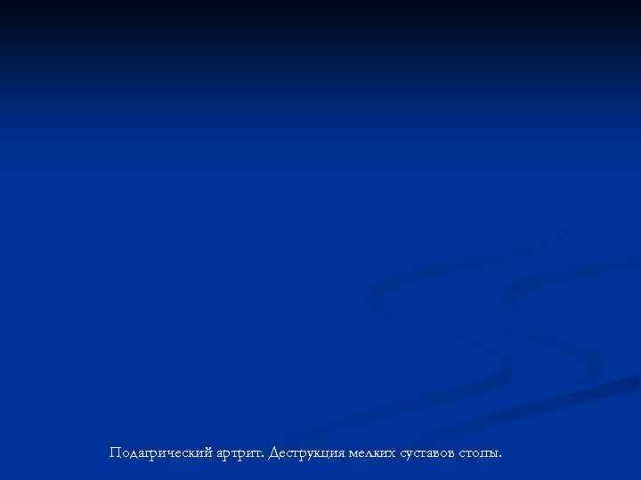 Подагрический артрит. Деструкция мелких суставов стопы. 