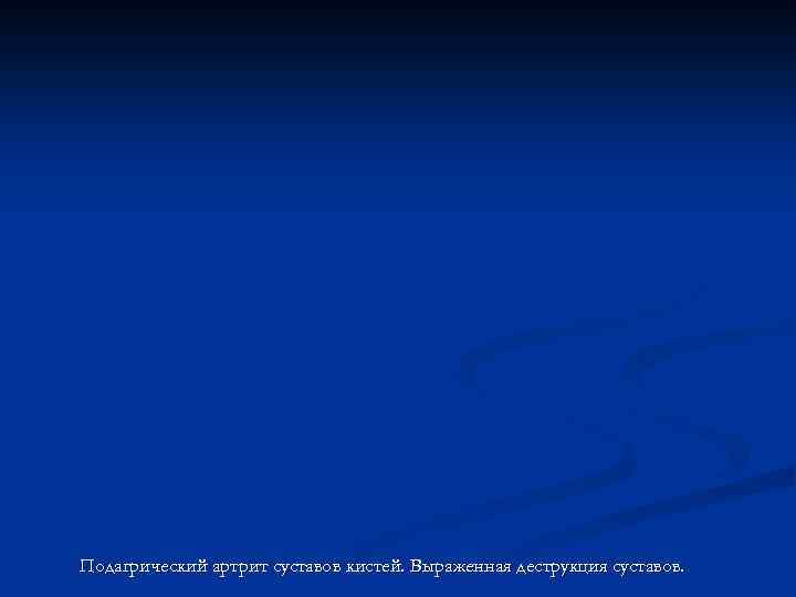 Подагрический артрит суставов кистей. Выраженная деструкция суставов. 