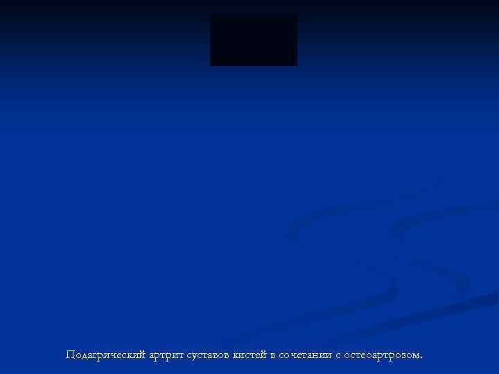 Подагрический артрит суставов кистей в сочетании с остеоартрозом. 