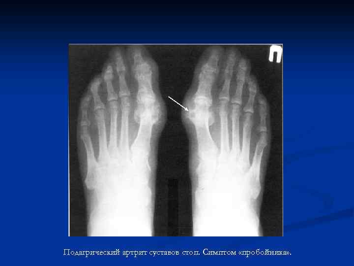 Подагрический артрит суставов стоп. Симптом «пробойника» . 