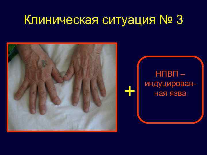 Клиническая ситуация № 3 + НПВП – индуцированная язва 