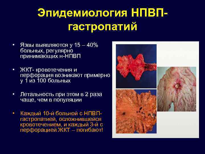 Эпидемиология НПВПгастропатий • Язвы выявляются у 15 – 40% больных, регулярно принимающих н-НПВП •