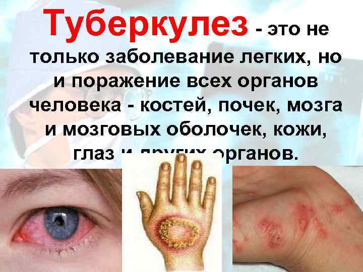 Туберкулез - это не только заболевание легких, но и поражение всех органов человека -