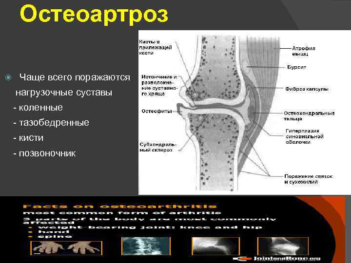 Наиболее яркая картина синовита с частыми обострениями наблюдается при остеоартрозе