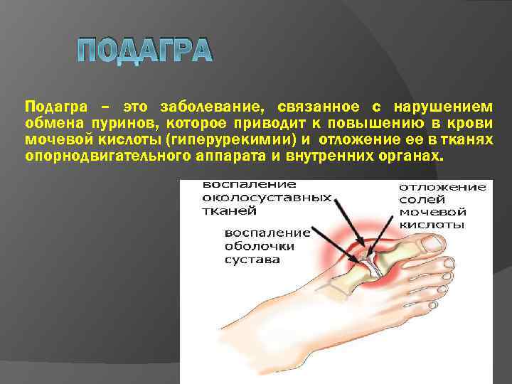 ПОДАГРА Подагра – это заболевание, связанное с нарушением обмена пуринов, которое приводит к повышению