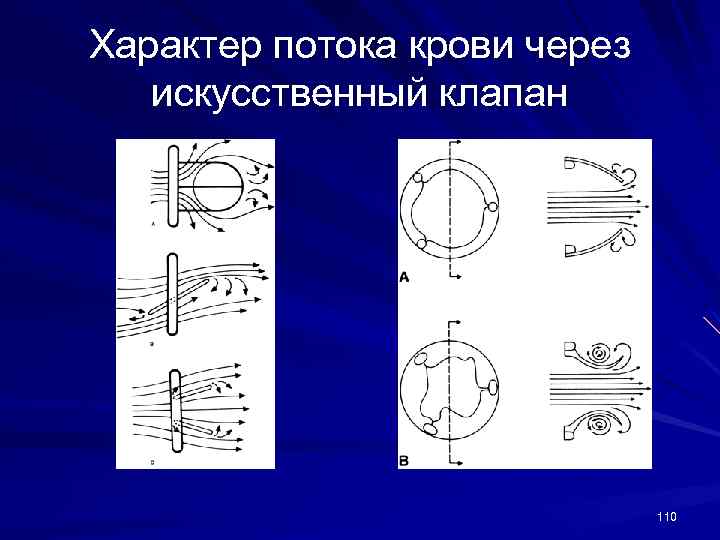 Характер потока крови через искусственный клапан 110 