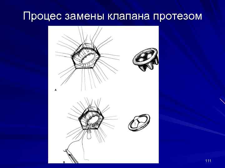 Процес замены клапана протезом 111 