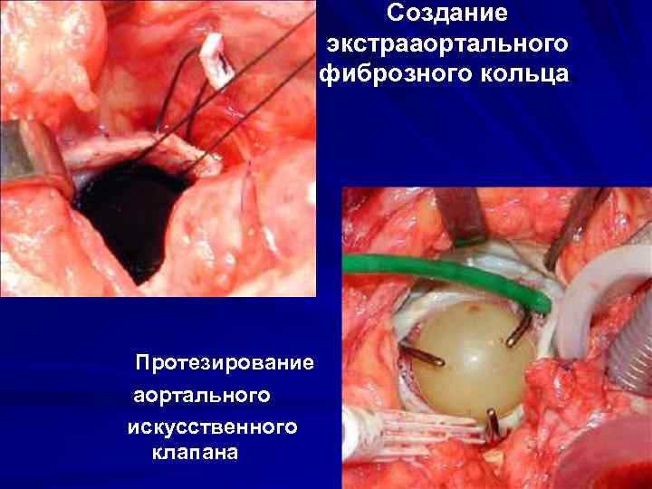 Создание экстрааортального фиброзного кольца. Протезирование аортального искусственного клапана 112 