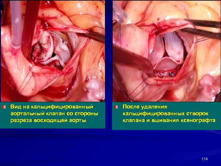 Вид на кальцифицированный аортальный клапан со стороны разреза восходящей аорты После удаления кальцифицированных створок