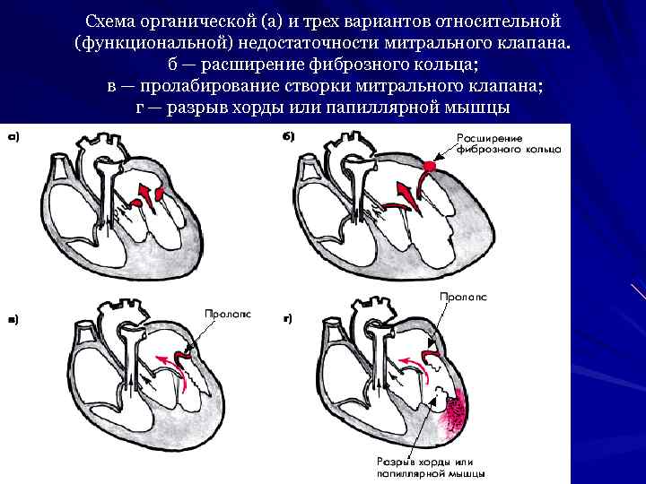 Схема органической (а) и трех вариантов относительной (функциональной) недостаточности митрального клапана. б — расширение