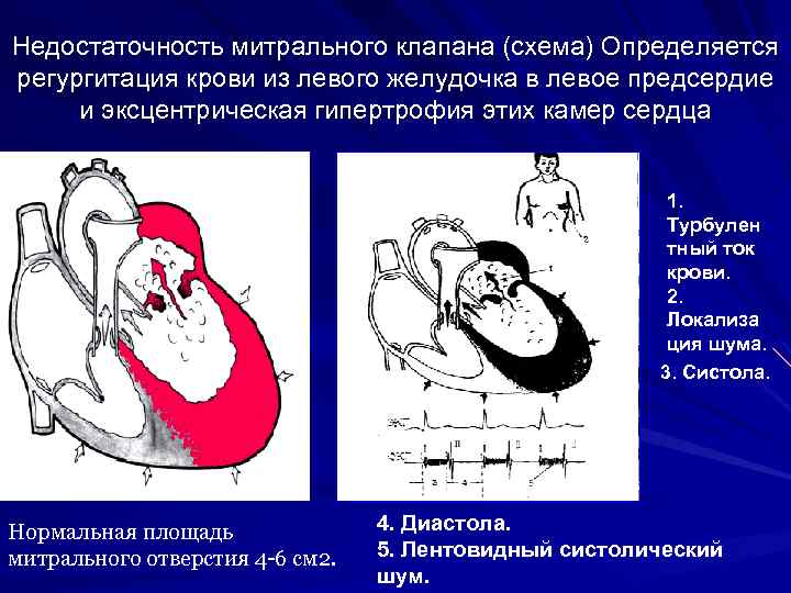 Недостаточность митрального клапана (схема) Определяется регургитация крови из левого желудочка в левое предсердие и