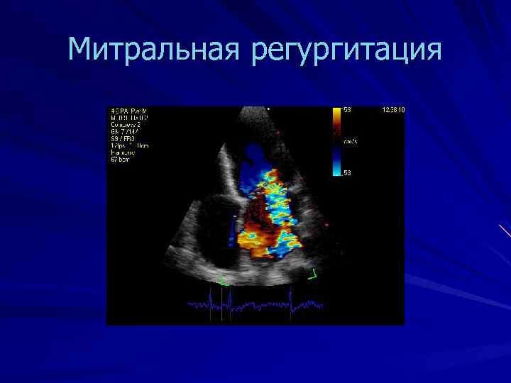 Что такое митральная регургитация