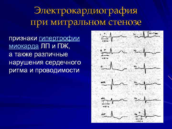 Электрокардиография при митральном стенозе признаки гипертрофии миокарда ЛП и ПЖ, а также различные нарушения