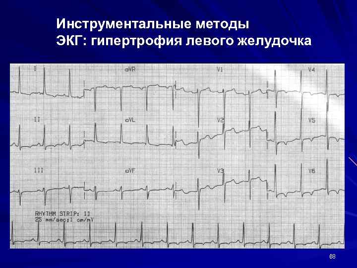 Инструментальные методы ЭКГ: гипертрофия левого желудочка 68 