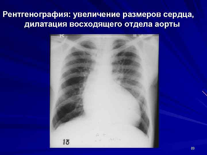 Рентгенография с прямым увеличением изображения применяется